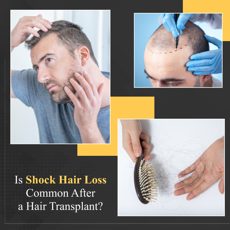 Shock Hair Loss After a Hair Transplant Surgery