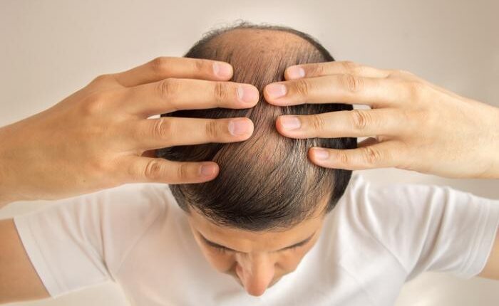 The Ultimate Guide To Hair Transplant in India