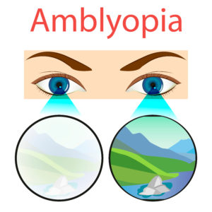 Amblyopia featured image