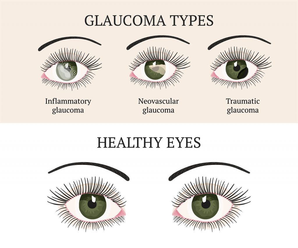 Glaucoma causes symptoms and prevention featured image.