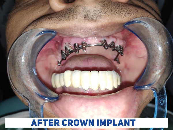 dental implant,dental surgery,dental clinic