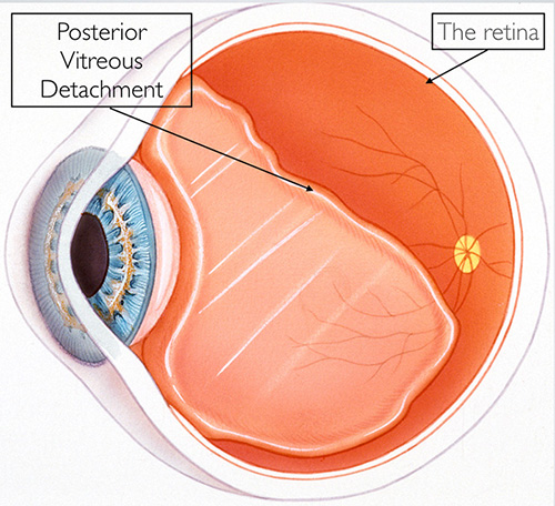 Posterior Vitreous Detachment (pvd) featured image