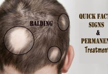 causes of bald spots- Balding: Quick Facts, Signs, and Permanent Treatment
