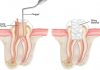 Root Canal Vs Extraction