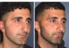 Nose Reduction Surgery
