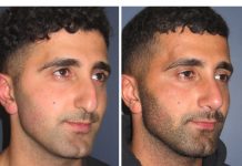 Nose Reduction Surgery