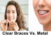 Clear Braces Vs. Metal Which One Is Better?