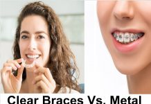 Clear Braces Vs. Metal Which One Is Better?