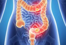 reating colon cancer