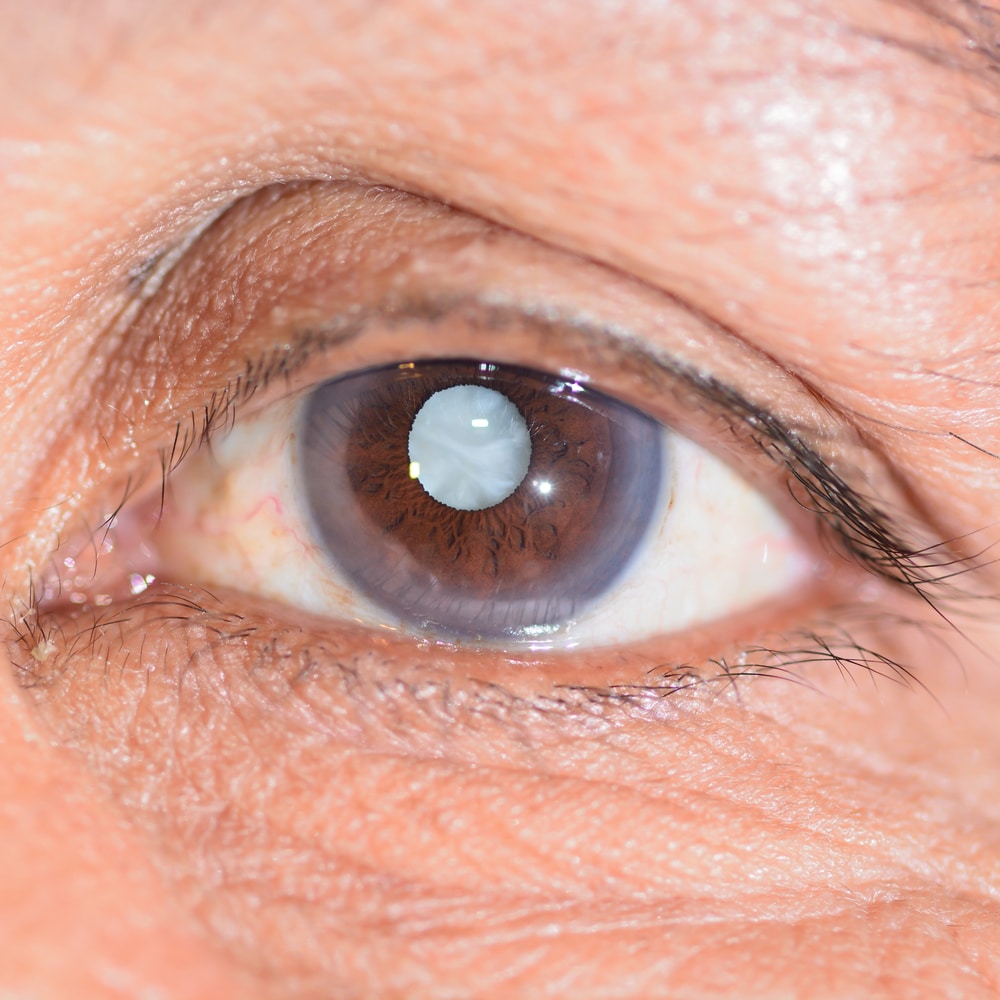 cataract featured image