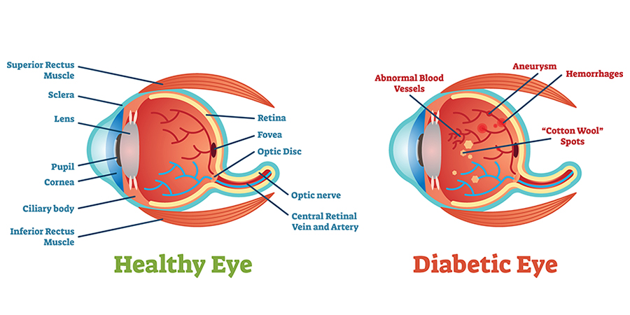 Diabetic Retinopathy featured image