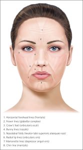 botox infusion for facial wrinkles and frown lines
