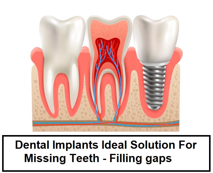 Dental Implants Southeast Edmonton